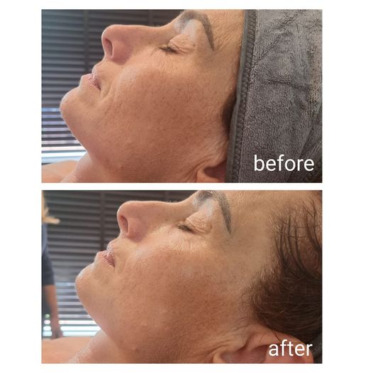 Voor en na HydroPeptide behandeling bij UvaCare
